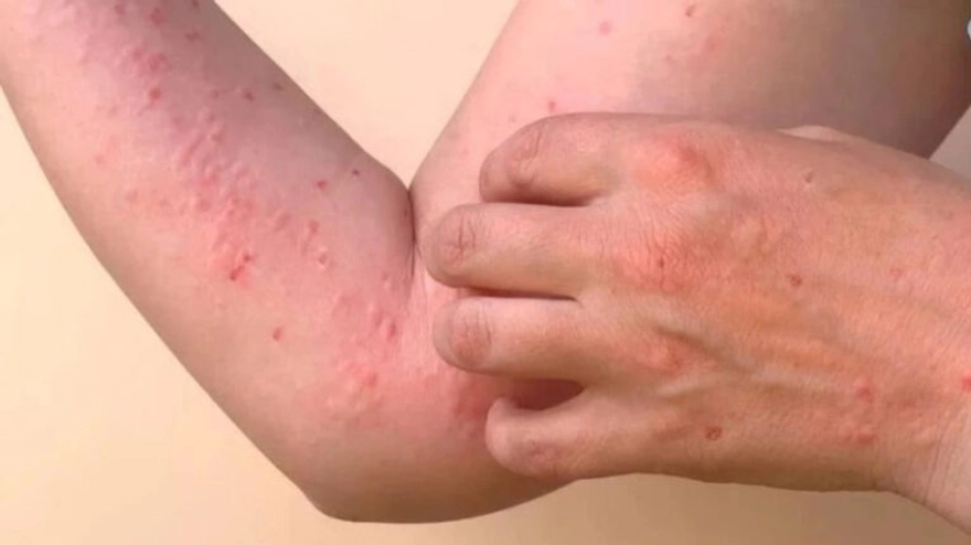  Dịch Chikungunya là gì, phòng tránh ra sao?