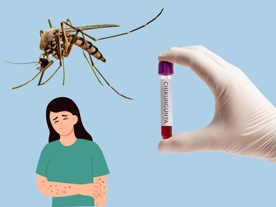  Dịch Chikungunya là gì, phòng tránh ra sao?