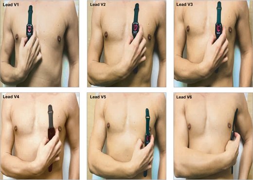 Apple Watch sử dụng đo cơn đau tim của người đeo